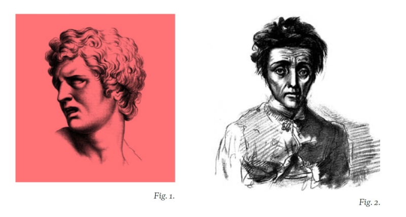 自古典時期開始，西方藝術家對捕捉「極端情緒表情」便相當感興趣。圖左為法國藝術家查理．勒布朗（Charles Le Brun, 1619-1690）所繪的「急性疼痛」（acute pain）。 右邊是1892年的印刷版畫。畫中的女病患似乎被疼痛折磨得精疲力竭，因而罹患憂鬱症。